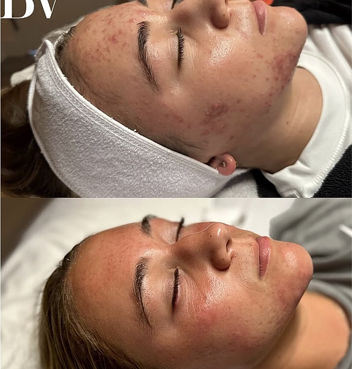 Dysport vial with cookies and milk background.