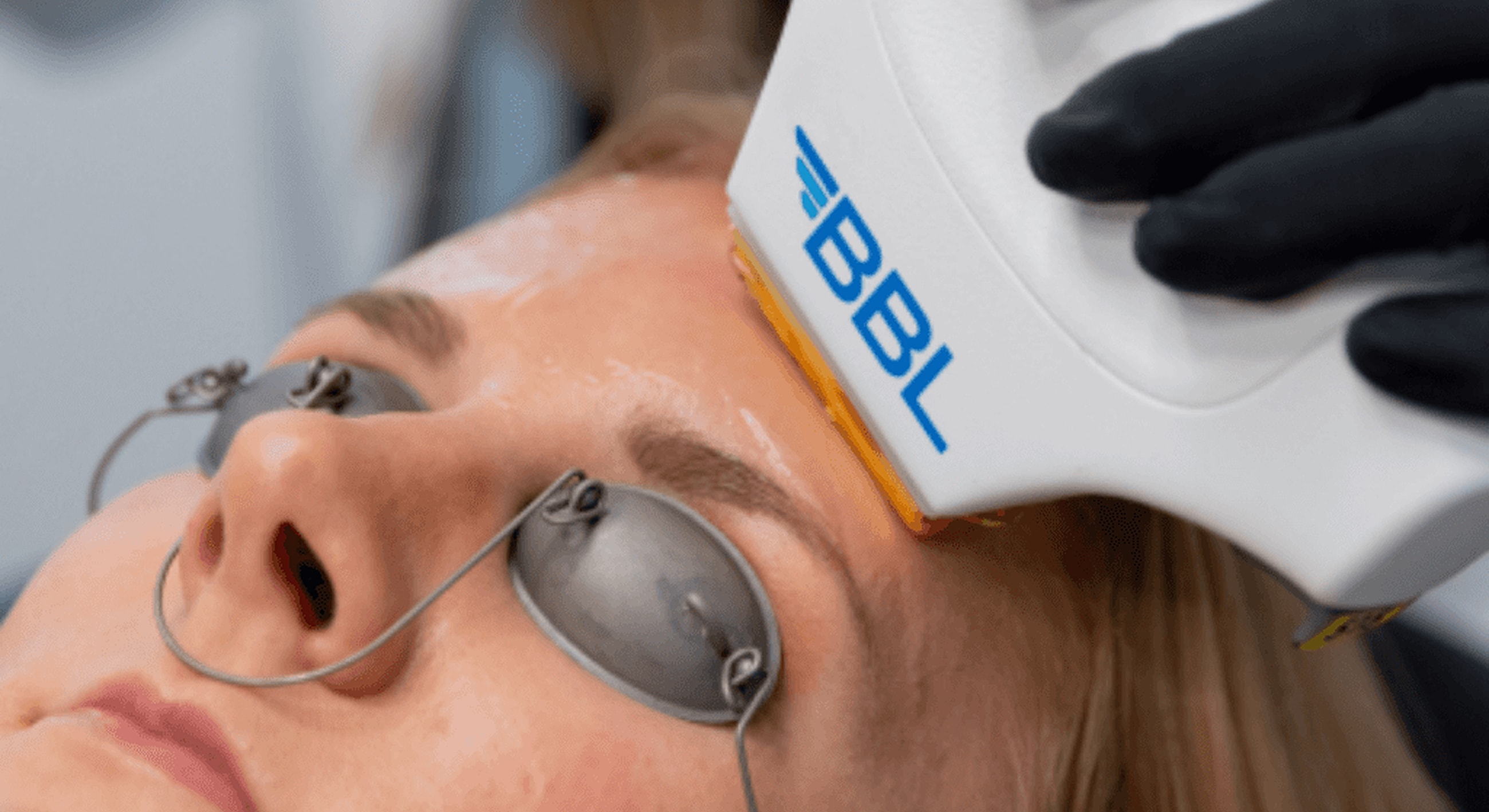 Patient receiving BBL facial treatment procedure.